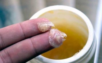 საშინაო მალამოს რეცეპტი, რომელიც შეგიმსუბუქებთ ტკივილს და თავიდან აგარიდებთ ართრიტის განვითარებას