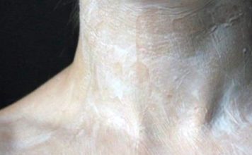 მკერდისა და დეკოლტის ზონაზე ნაოჭების გაჩენა და გაღრმავება თავიდან რომ აირიდოთ, გამოიყენეთ მარტივი საშინაო რეცეპტი